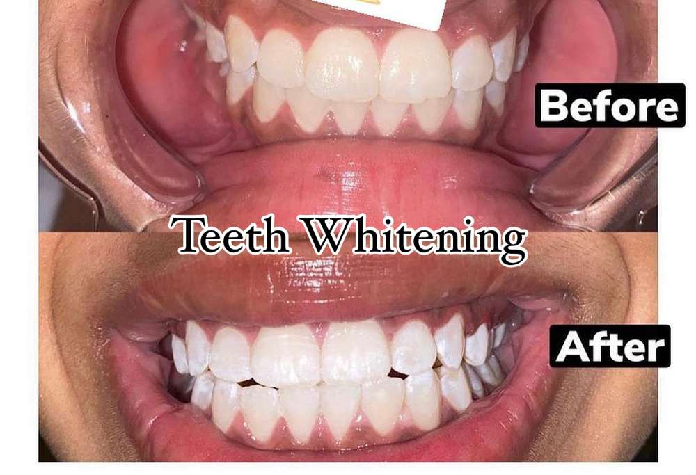 60 Min Teeth Whitening at KB Beauty Bar in Lake Elsinore, CA