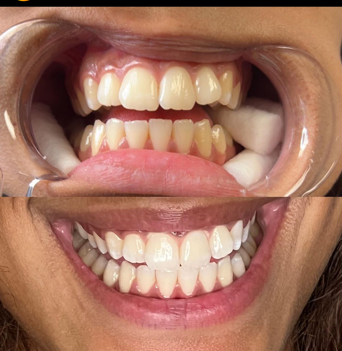 1 HOUR TEETH WHITENING
