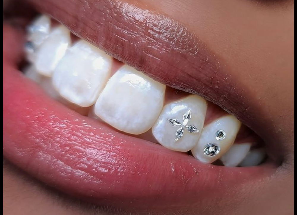 Tooth Gems