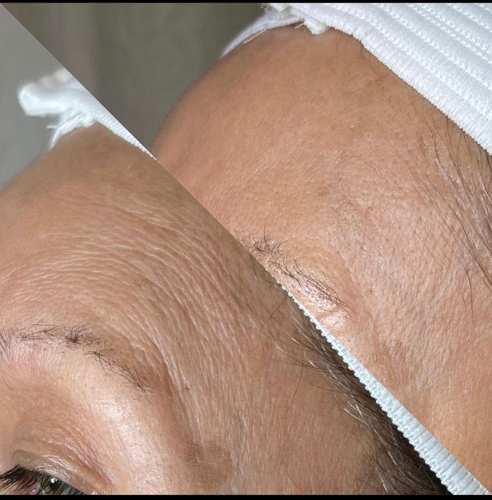 Microneedling Facial at Jisell Aesthetics in Houston, TX
