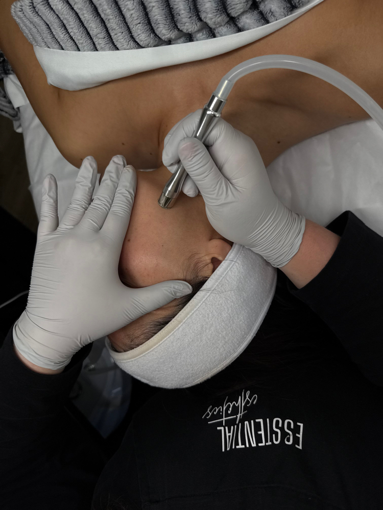 Microdermabrasion ADD-ON