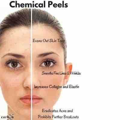 Chemical Peel Facial w/ Hydrojelly