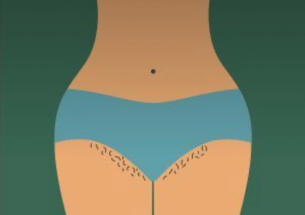 360 Full Brazlian Package