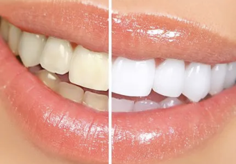 Basic Cosmetic Teeth Whitening