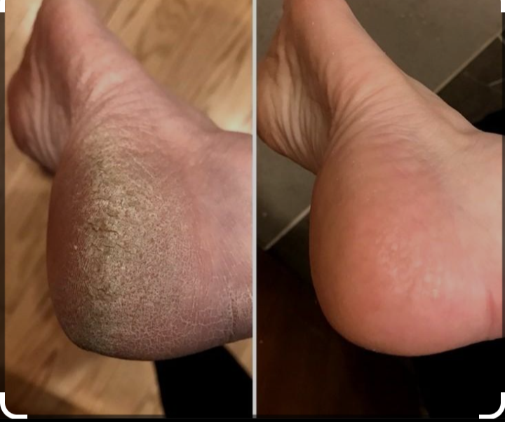Medical Callus Reduction Treatment