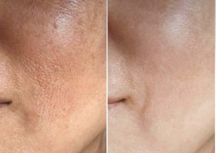 Pigment Peel with Facial