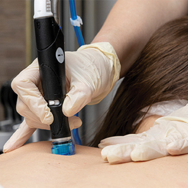 Clarifying Back Treatment