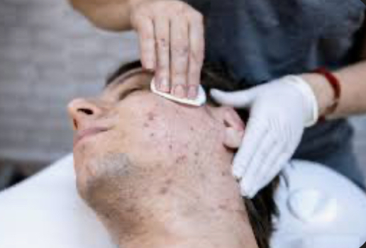 Acne Facial