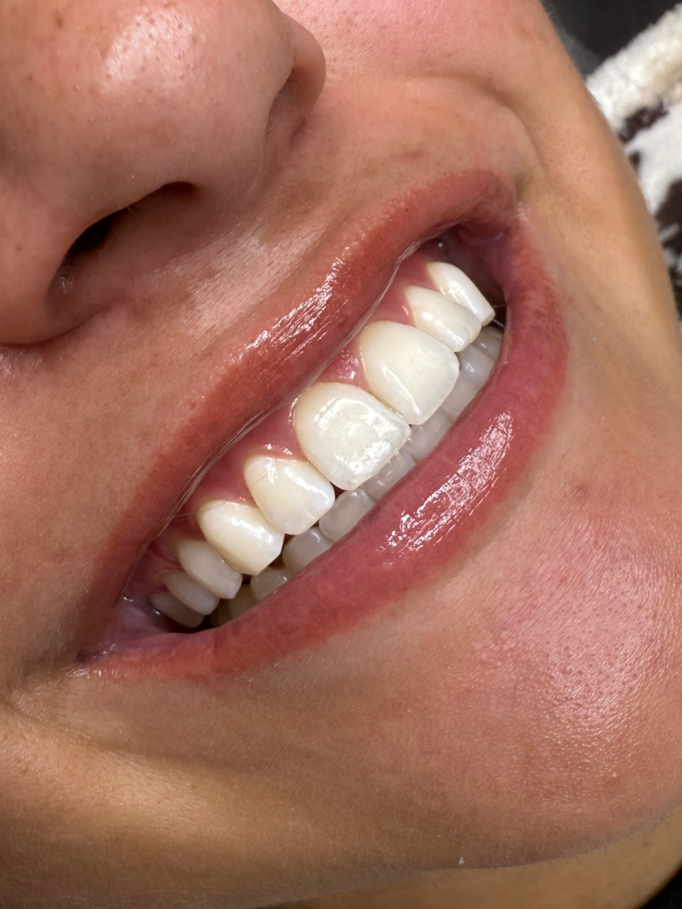 Teeth Whitening Basic