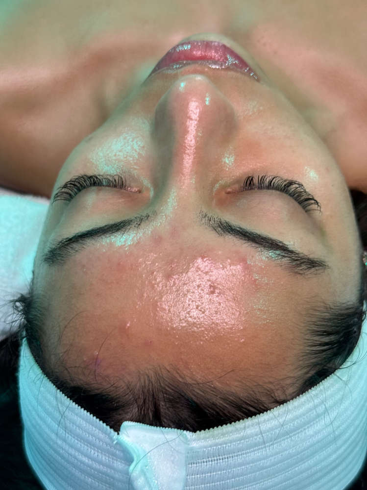 NEW CLIENT- ACNE (START HERE)