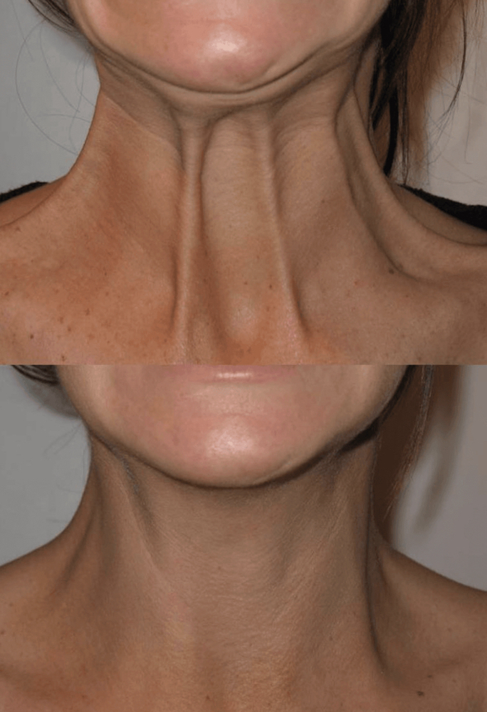 Platysmal Band Injections