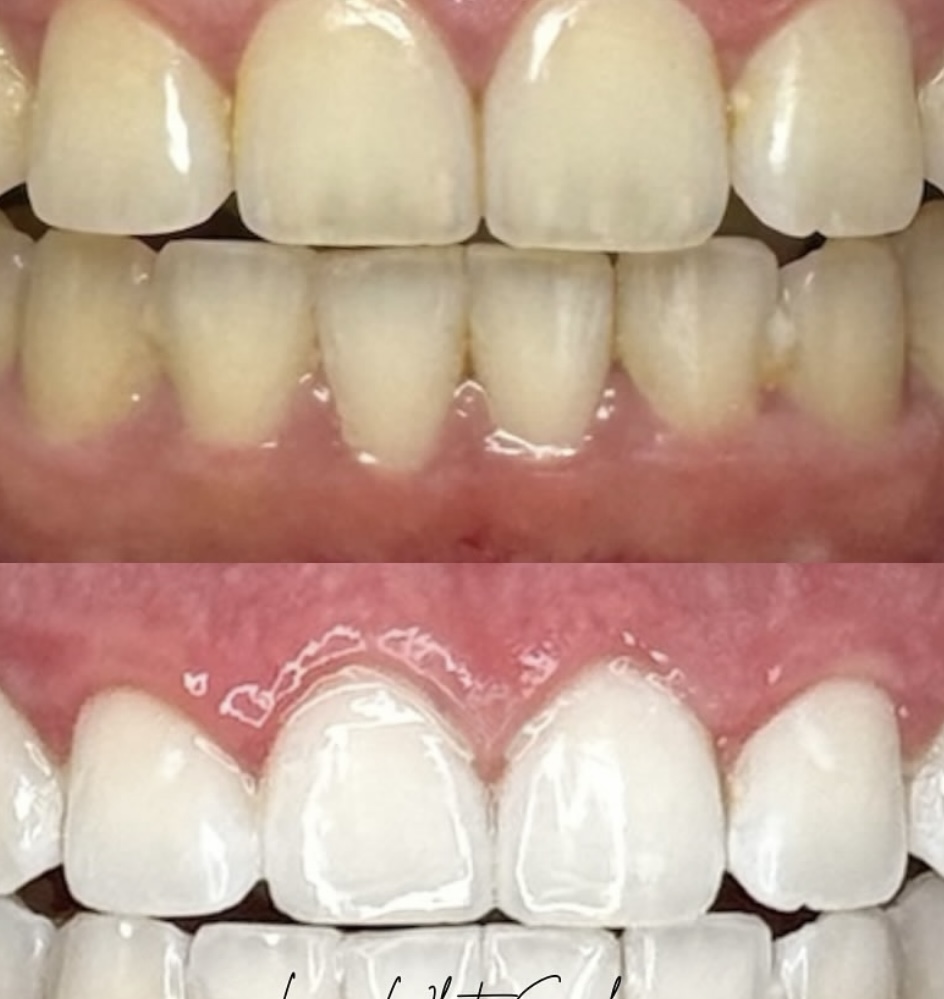 Ultra Teeth Whitening