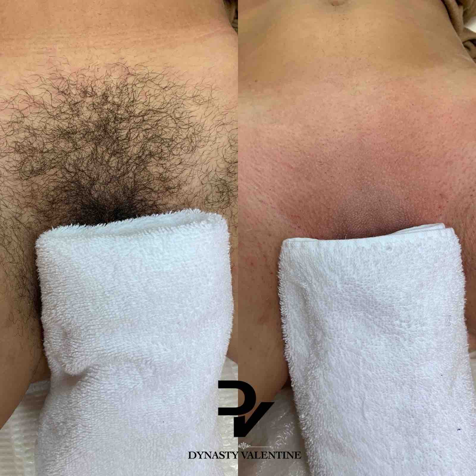 Brazilian Wax
