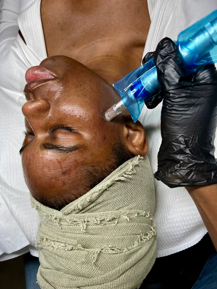 7. Microneedling