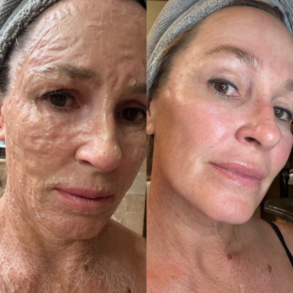 Firming Enzyme Treatment at Sol Skin in Chandler, AZ