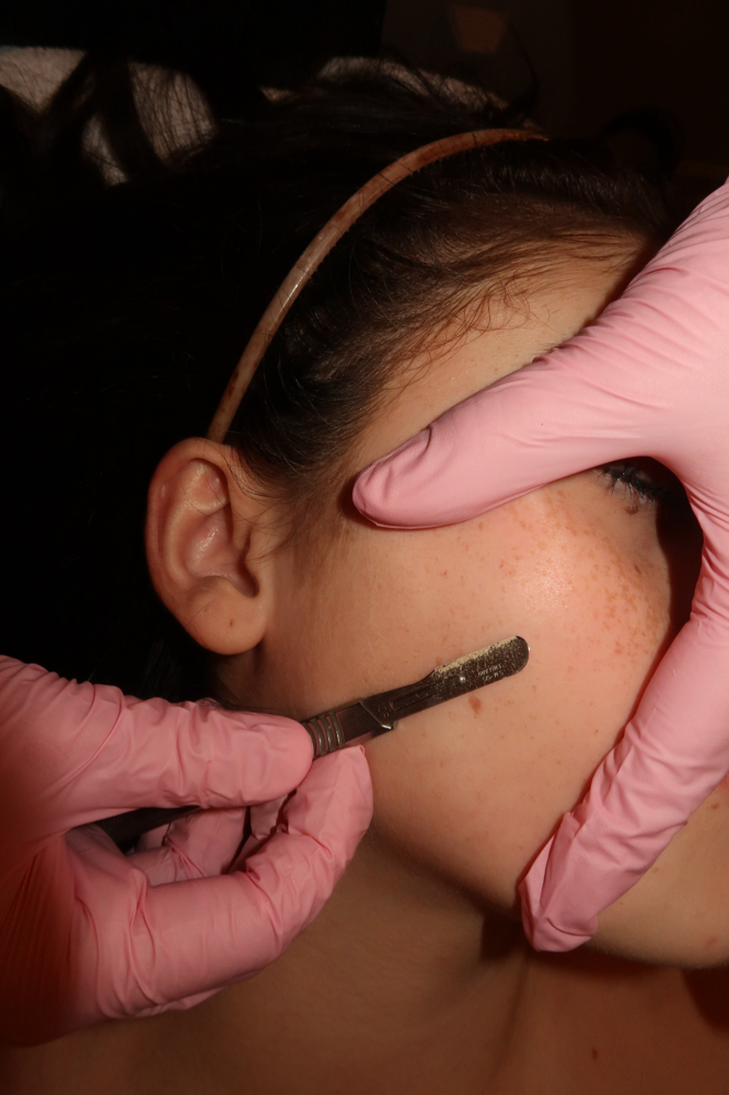 Add on Dermaplane