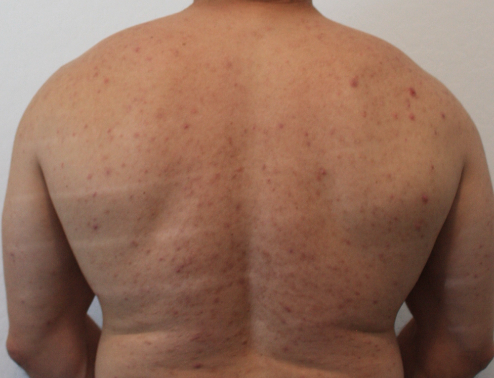Acne Scar Reduction - Body