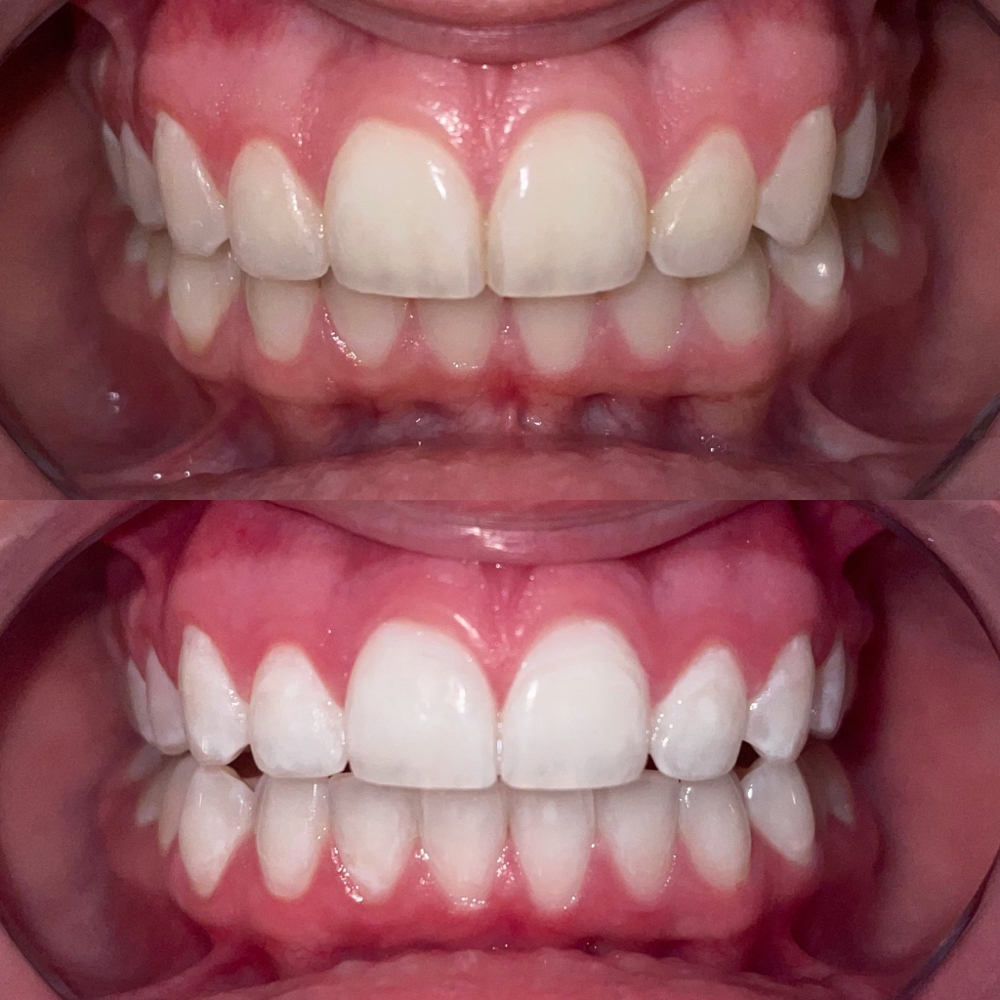 Natural Teeth Whitening