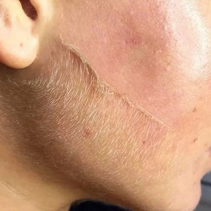 ADD ON - Dermaplaning