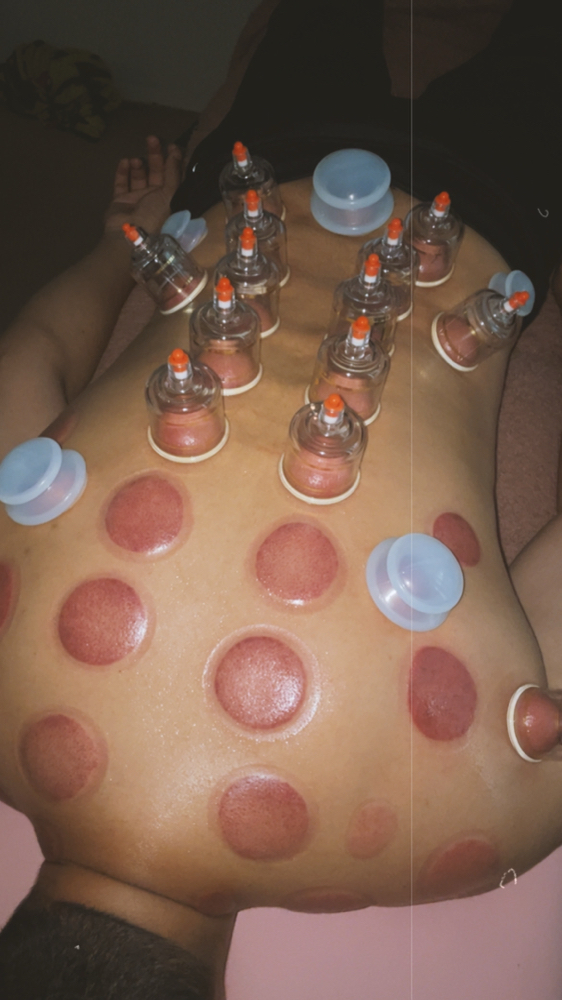 Cupping Therapy