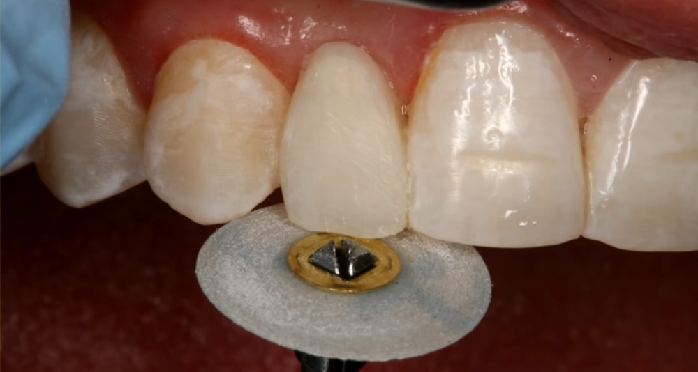 Tooth Repair Priced Per Tooth