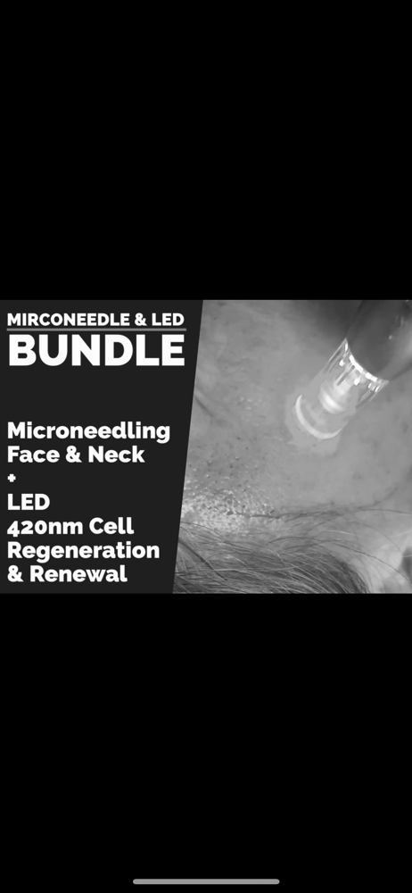 Microneedling Face & Neck W/ LED