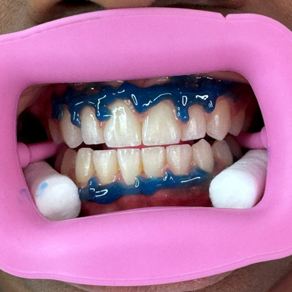 Teeth whitening Per Session at Aesthetics By Velvet Master in San Antonio, TX