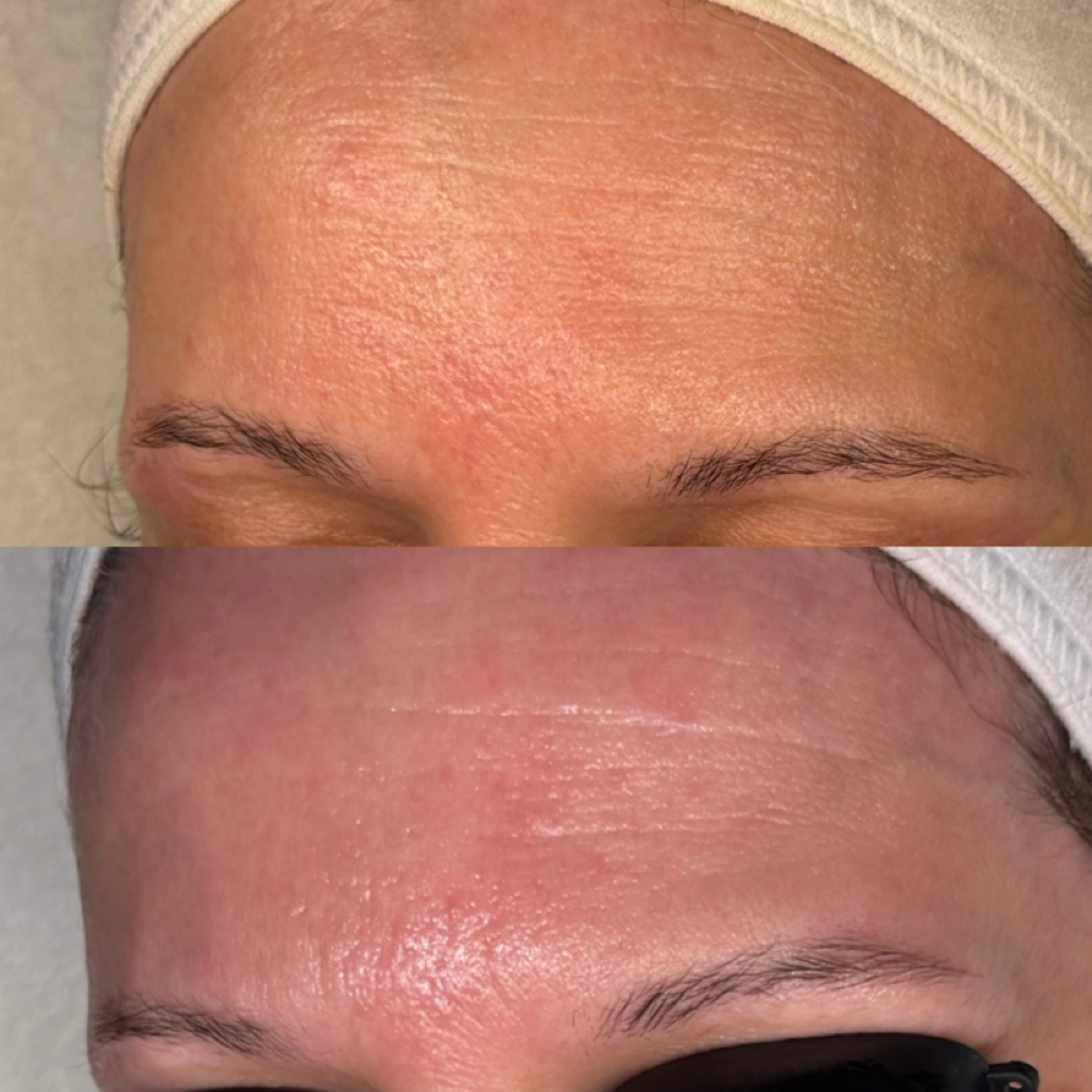 Glymed+ 5 Berry Peel with 7% TCA at Esthetics By Mikayla in Carmel, IN