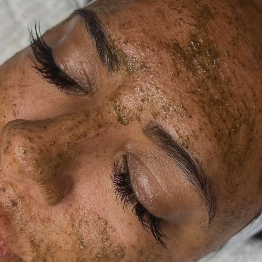 Liquid Microneedling at Skin Deep Esthetics in Columbus, MS