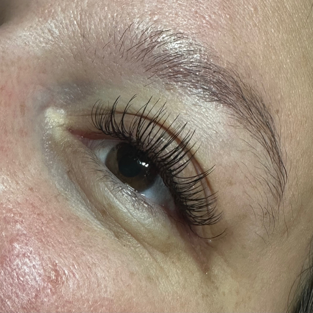 Natural Fill at Zen Esthetics in Greensburg, PA