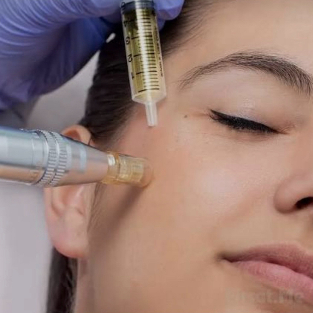 Microneedling at Kelly C Aesthetics in Lutz, FL