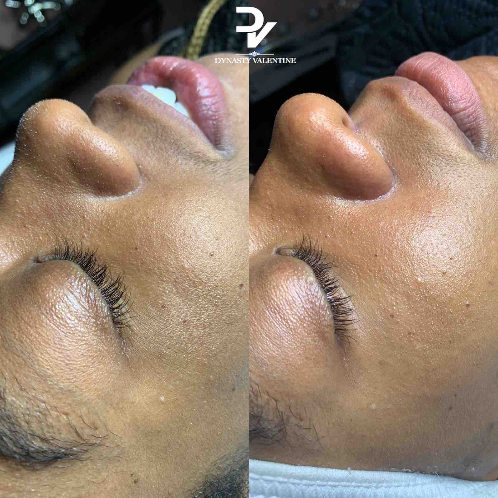 Dermaplane Facial