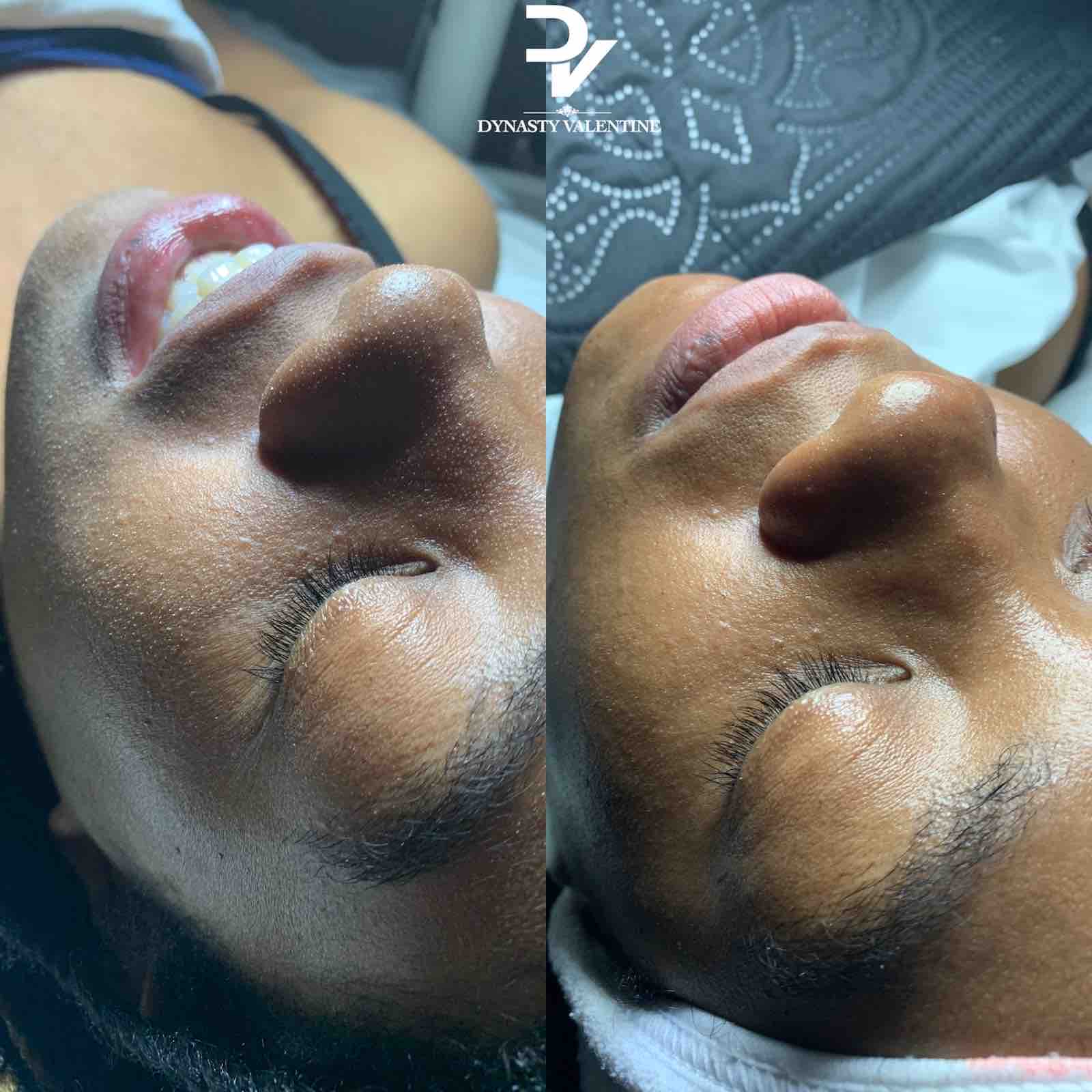 Hydration Facial