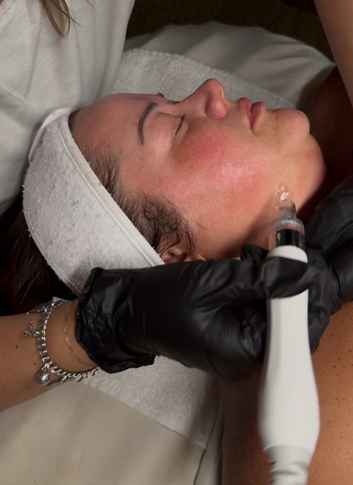 Hydrodermabrasion - ADD ON at Esthetics with Ali in Burleson, TX