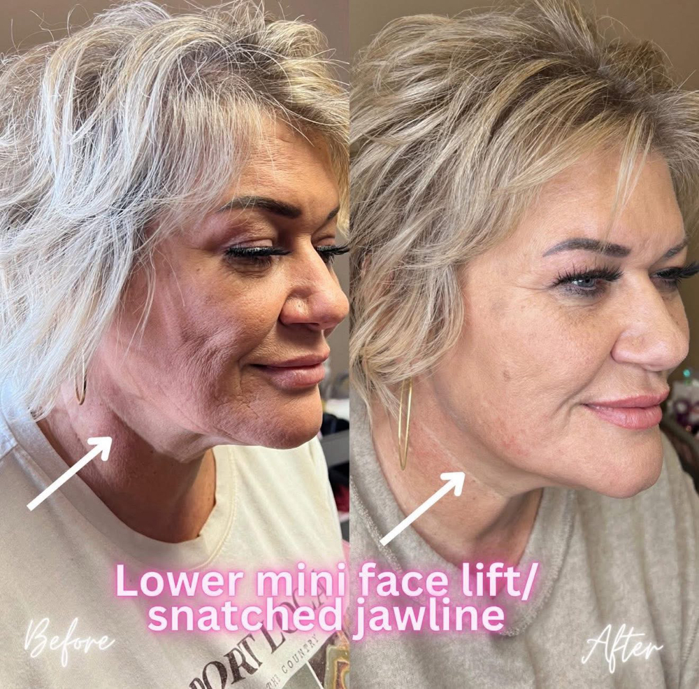 Tox-Mini Lift With Flip💉 at BeautyHolic Aesthetics LLC in Lubbock, TX