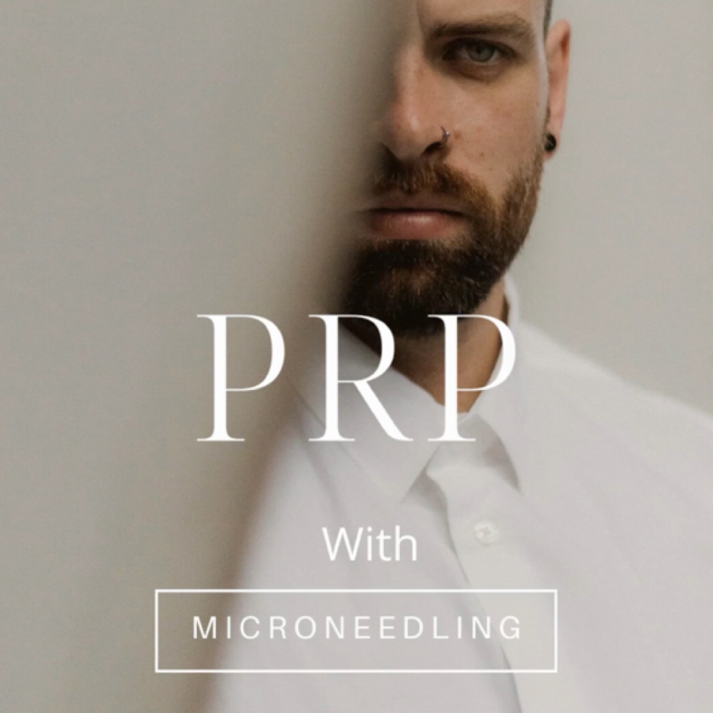 MicroNeedling With PRP at Lulu beauty spa in Chandler, AZ