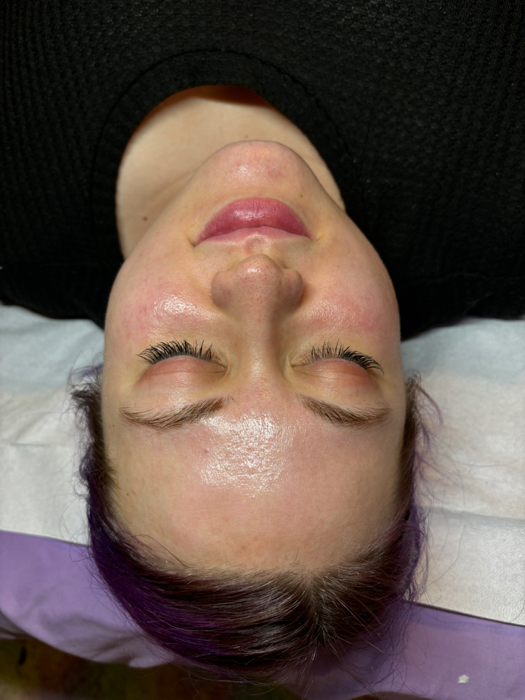 Dermapeel