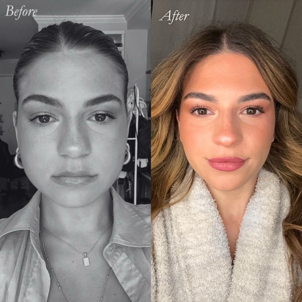Masseter Botox (Face slimming) at Lavish.withLo in Sunnyvale, TX