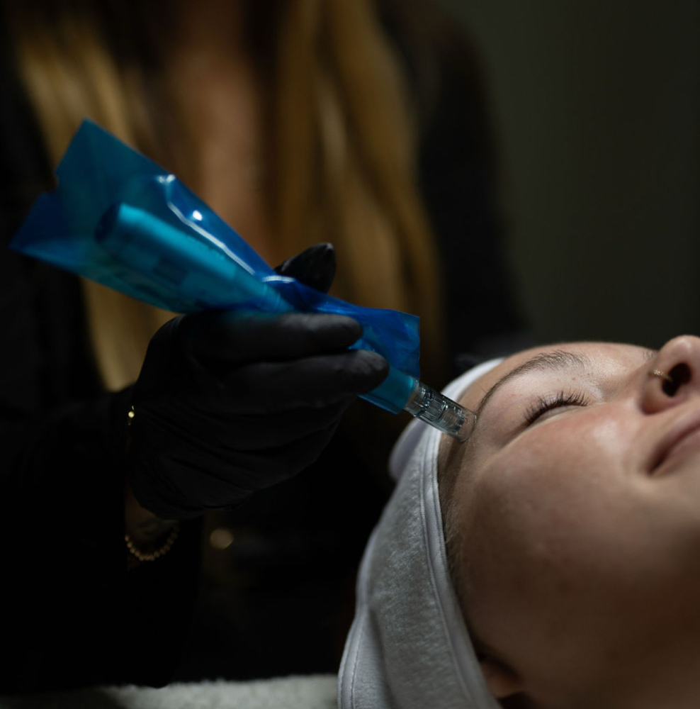 Microneedling Treatment (Face Only)