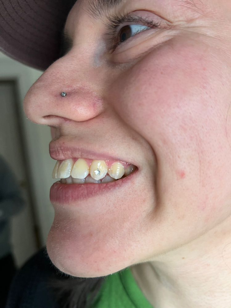 Tooth Gem Application