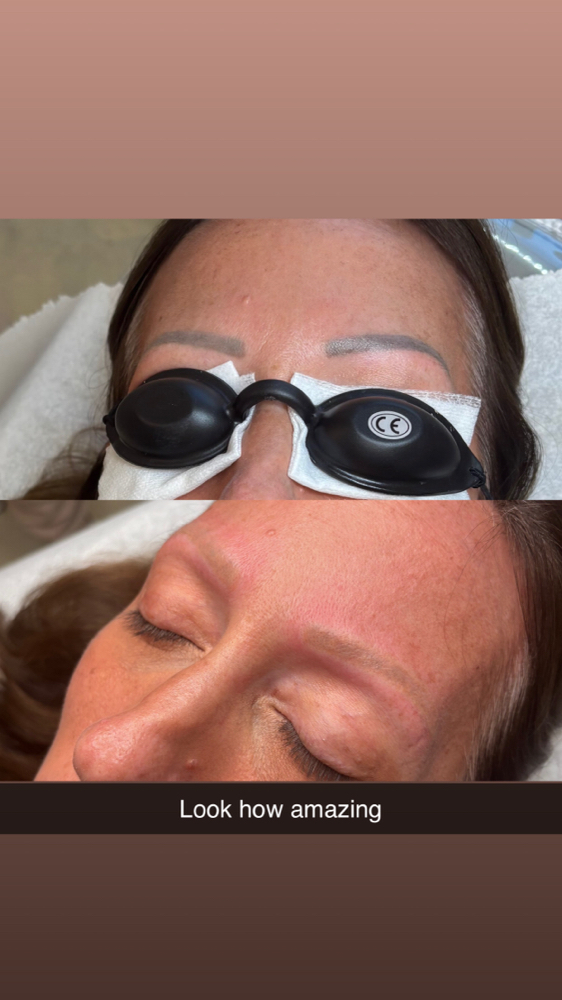 Laser PMU Brow Removal / Lip Blush