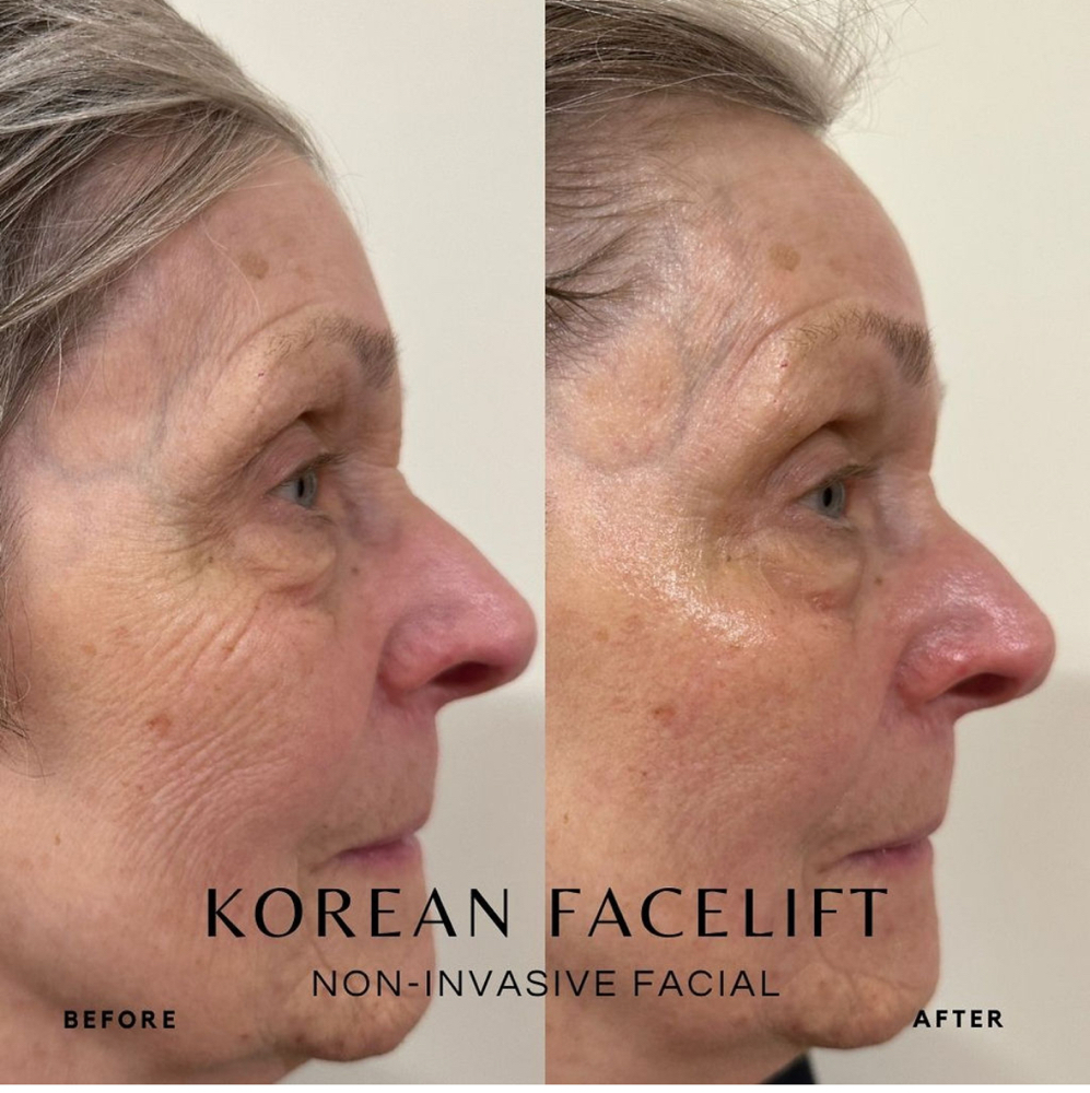 K-Beauty Signature Face Lift at C. Walker Skin Company in Cookeville, TN