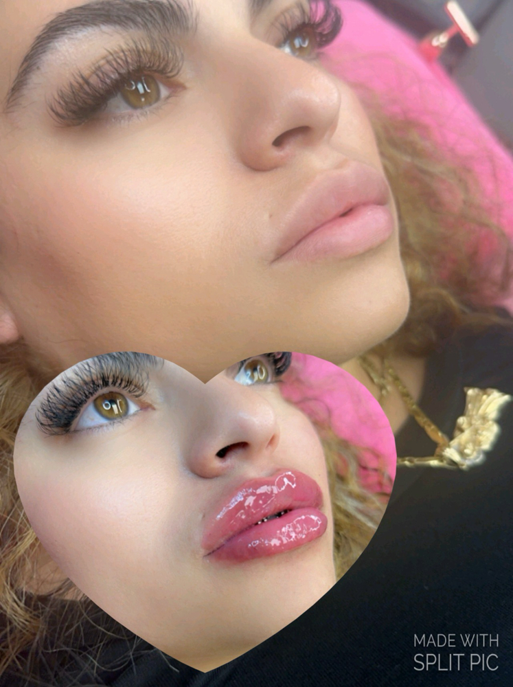 Lip Augmentation 1.5💉
