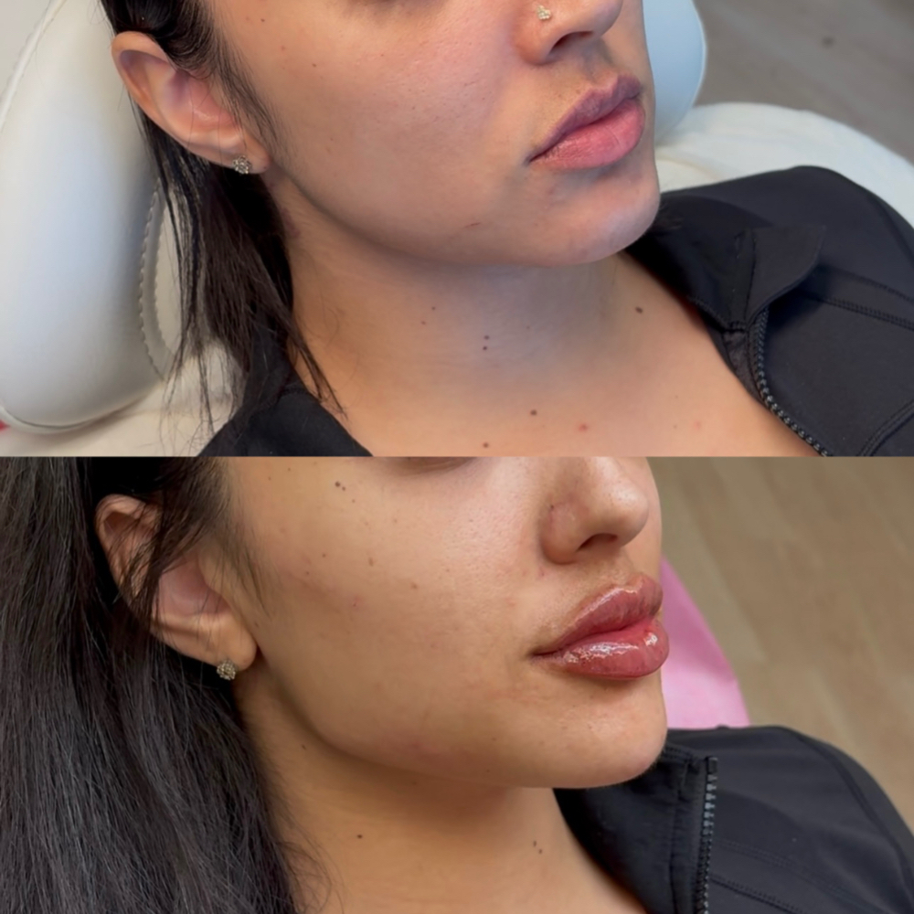 Jawline Filler at Balance.Bar.Aesthetics in Berkeley, CA