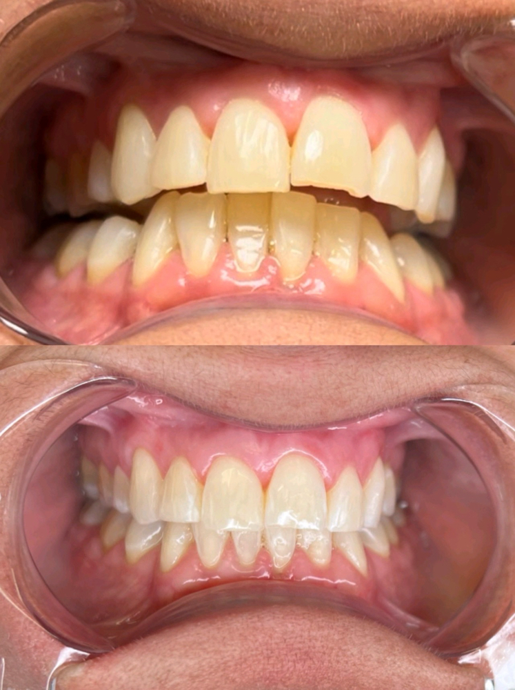 Teeth Whitening- 60 Minute
