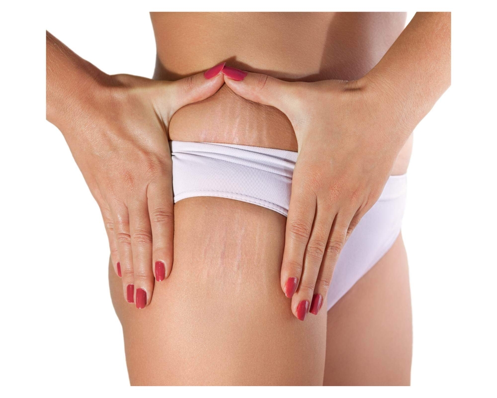 STRETCH MARKS  Inkless (Body Part)