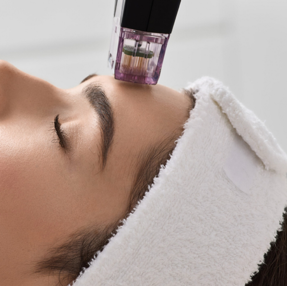 RF Microneedling Sessions (4) at Chatuge Med Spa & Fitness in Hiawassee, GA