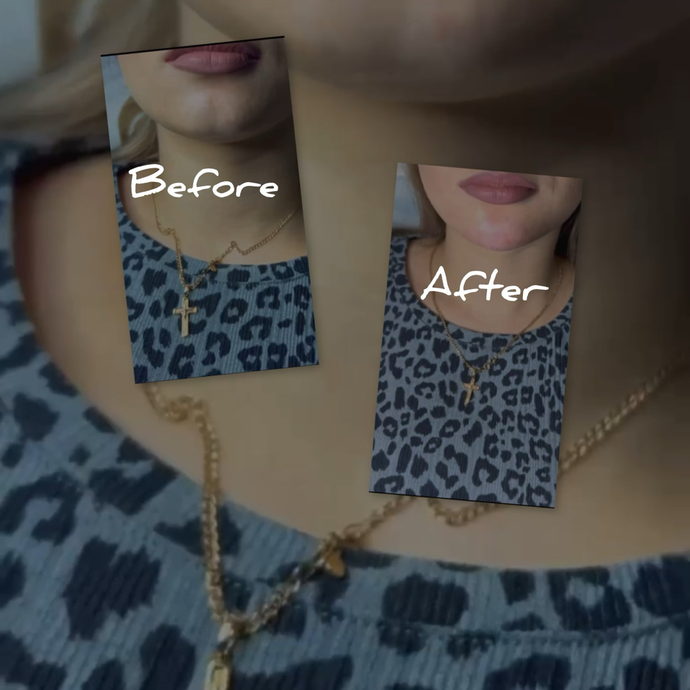 CHIN FILLER