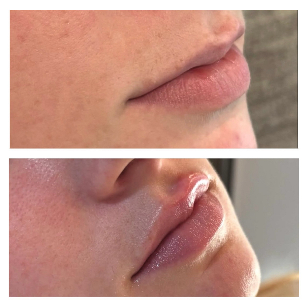 1/2 Syringe Filler at Magnolia Wellness and Aesthetics