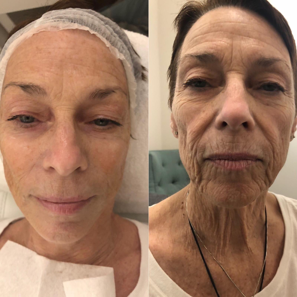 Non Surgical Face Lift